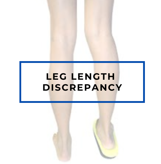 Leg Length Discrepancy 